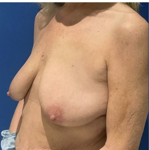 Breast Augmentation #8 590 cc-before