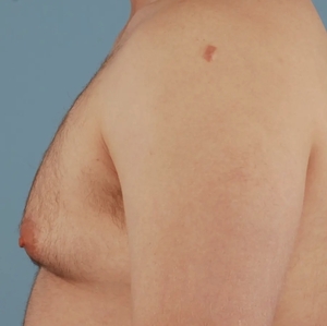 Male Breast Reduction #12-before