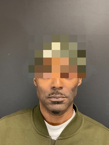 Before and after for nasolabial folds. #ultra-after