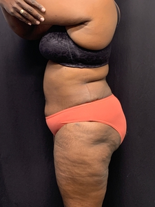 Tummy Tuck w/ plication + liposuction-low back + waist-before