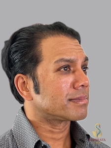 Nouvaderm Micro, PladuoPro and Cellenis Derma PRP one treatment-after