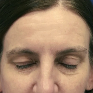 Brow & Eye Lift #1-before