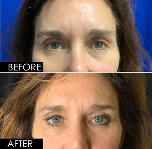 Upper & Lower Blepharoplasty-before