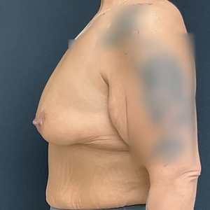 Breast Augmentation #23 435 cc-before