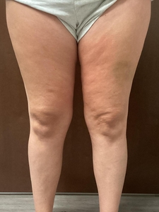 6 Emtone Inner Thighs-before