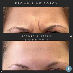 Botox-before