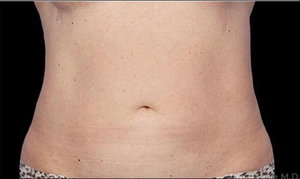 Liposuction - Abdomen-after