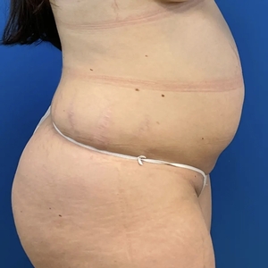 Lipo w Renuvion #8-before