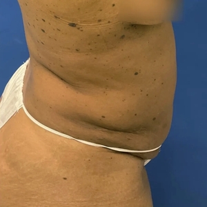 Lipo w Renuvion #6-after