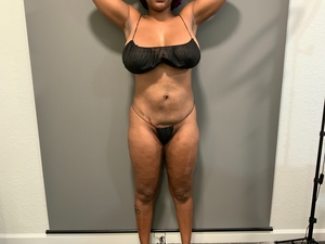 Denise Strickland Anterior-after