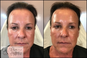 Radiesse Cheeks-after