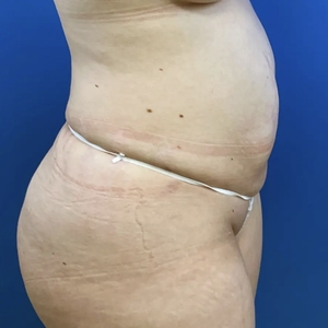 Lipo w Renuvion #8-after