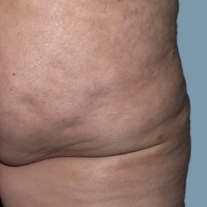 Cellulite Reduction #1-after