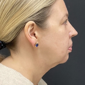 Lipo w Skin Tightening Face #3-after