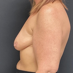 Breast Augmentation #22 350/410 cc-before
