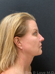 58 year old - MyEllevate, FaceTite, Morpheus8/Factora, Sculptra, Restylane Kysse-after