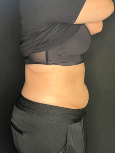 Ashley Reich RN. - Lower Abdomen-before