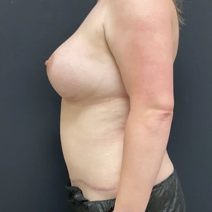 Mommy Makeover #11-after