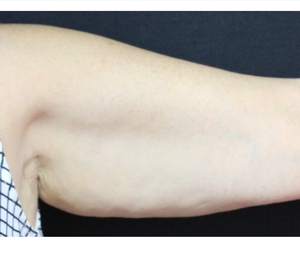Arm Contouring-before