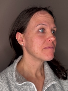 Krista Dalley- BBL face-before