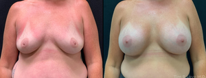 5'5 157# 1 mo post-op Highly Cohesive Shaped Gel Augmentation-before