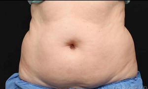 Liposuction - Abdomen-before