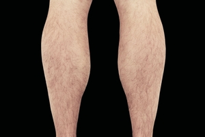 4 Treatments-before