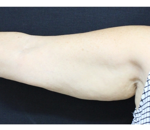 Arm Contouring-before
