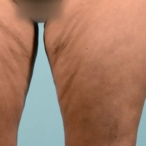 Cellulite Reduction #4-before