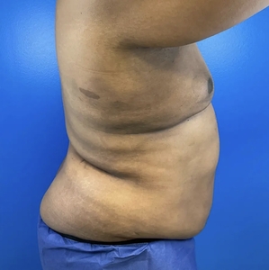 Male Breast Reduction #1-after