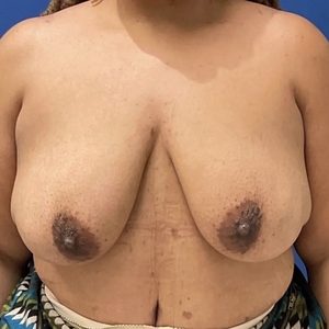 Breast Lift #6-before