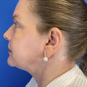 Lipo w Skin Tightening Face #8-after