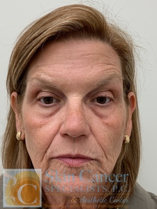 Sculptra and Botox-after
