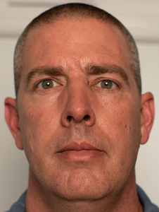 April Before Any Treatments-before