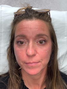 Tear trough Filler volbella-after