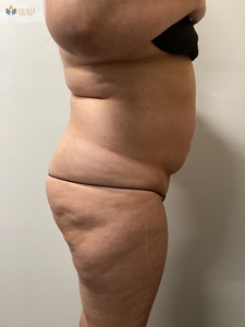 After 1 instasculpt treatment-before