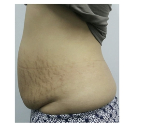 Body Contouring-before