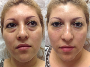 Tear trough filler-before