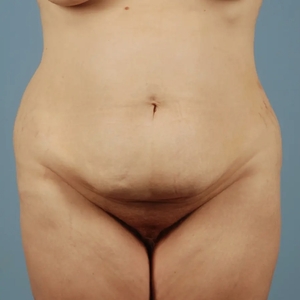 Mommy Makeover #12-before