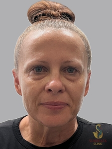 Cellenis Derma 11 ML kit, tear troughs and Cheeks-after