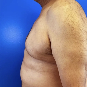 Male Breast Reduction #2-after