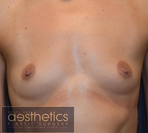 Sientra Teardrop Gel: 485cc-before