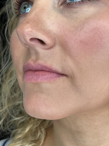 1 syringe Restylane Kysse in lips-before