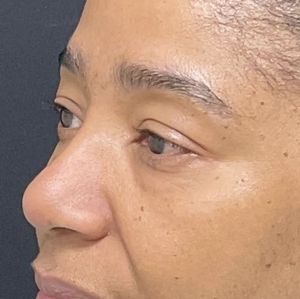 Brow & Eye Lift #3-before