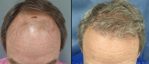 2500 grafts-before