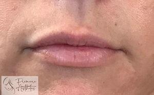 Lips-Restylane Defyne-before