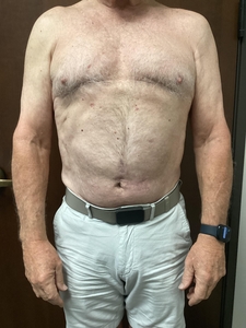 4 Abdomen + 4 Edge. 4 weeks after last treatment.-after