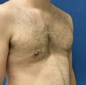 Male Breast Reduction #5 (right oblique)-after