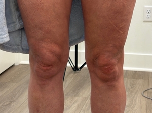 Rejuvenation above the knees-after