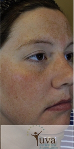 4 vitalize peels-before